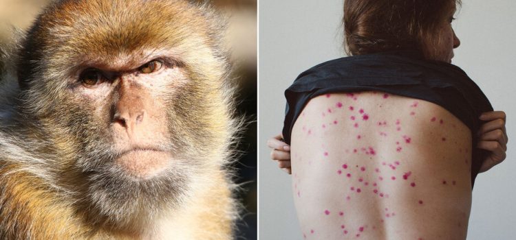 Investigan desechos humanos en busca del patógeno Monkeypox.